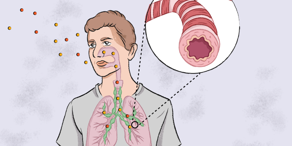 Asthme : Comprendre et Prévenir une Maladie Respiratoire Souvent Banalisée