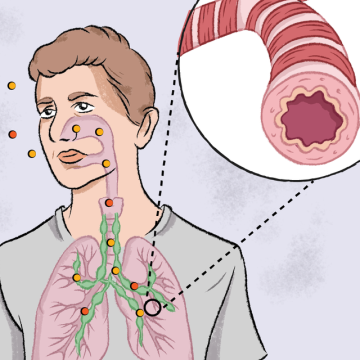Asthme : Comprendre et Prévenir une Maladie Respiratoire Souvent Banalisée