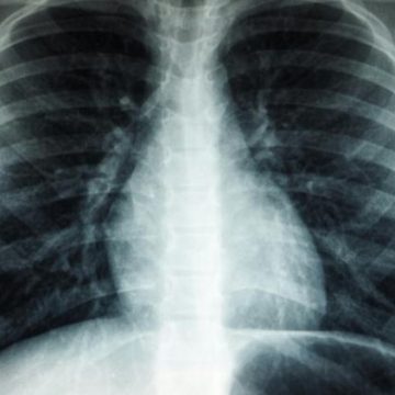 Un nouveau programme de dépistage automatisé pour le cancer du poumon