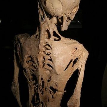 Fibrodysplasie Ossifiante Progressive : Décrire une Maladie Génétique Rare