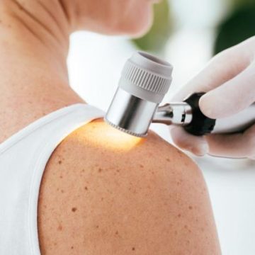 Une méthode innovante pour détecter les cancers de la peau
