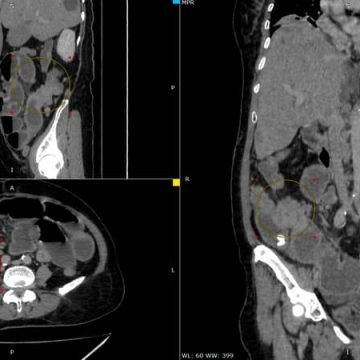 La dangerosité des vermifuges vendus sur le marché noir comme traitement du cancer