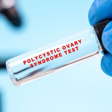 Le syndrome des ovaires polykystiques devient le syndrome métabolique ovarien polyendocrinien