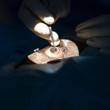 La greffe de cornée en France : un espoir pour la vision
