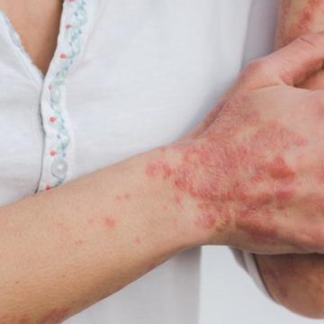 a2ae9978-bff7-49e2-ac62-eda3d3a3571e Avancées dans le traitement du psoriasis résistant