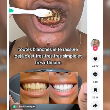 Les dangers des recettes maison pour blanchir les dents